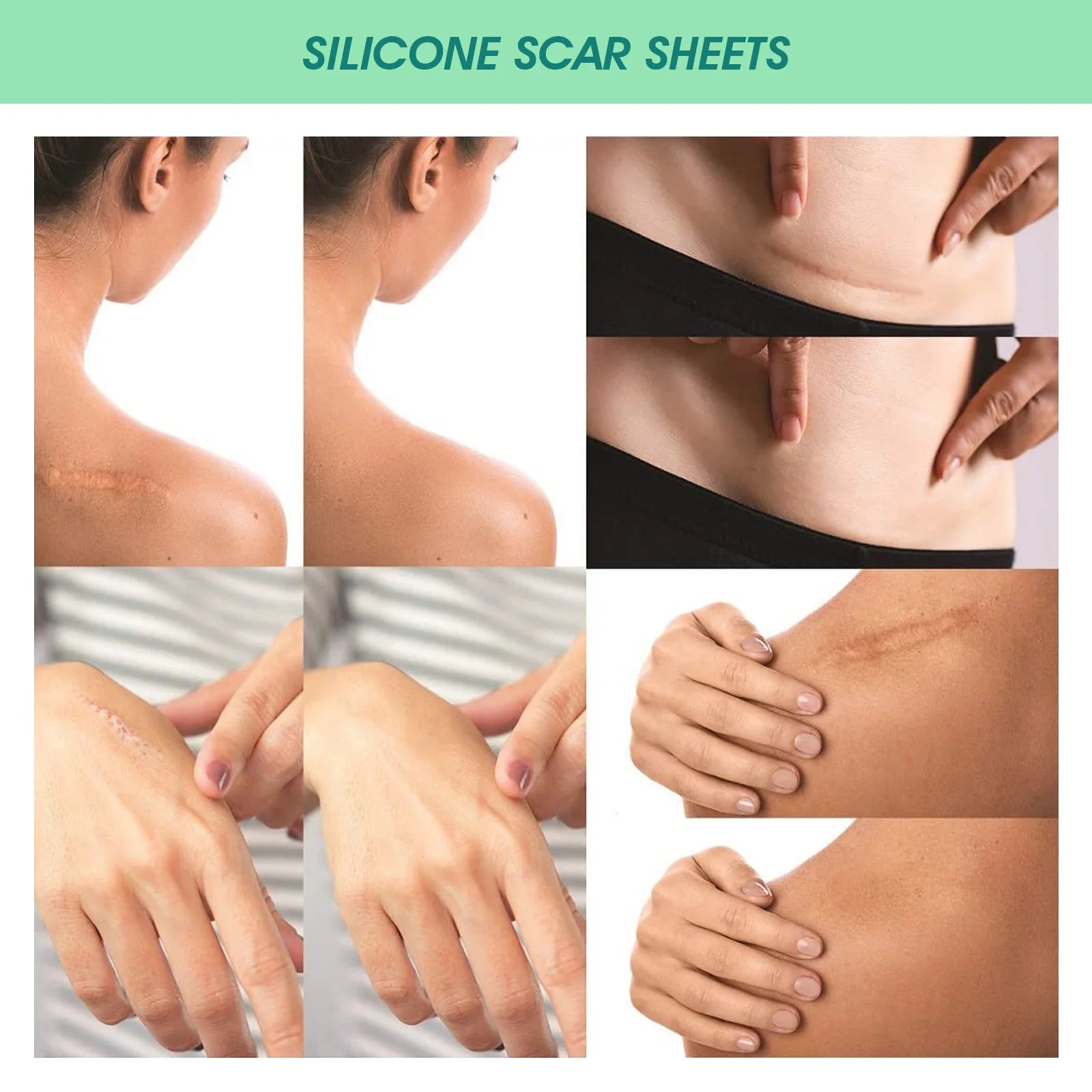 Scar Patches Remove Silicone Gel Sheet Correctors Burn Wounds Efficient Surgery Scar Tape Skin Repair Self-Adhesive Scar Cover EVERYDAY ESSENTIALS